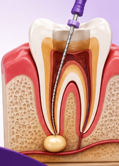 Root Canal Treatment